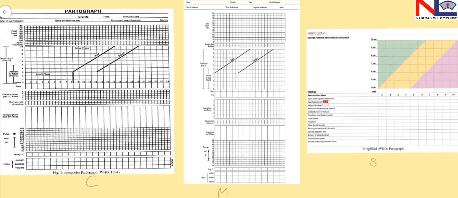 Partograph