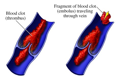 thrombosis-embolism